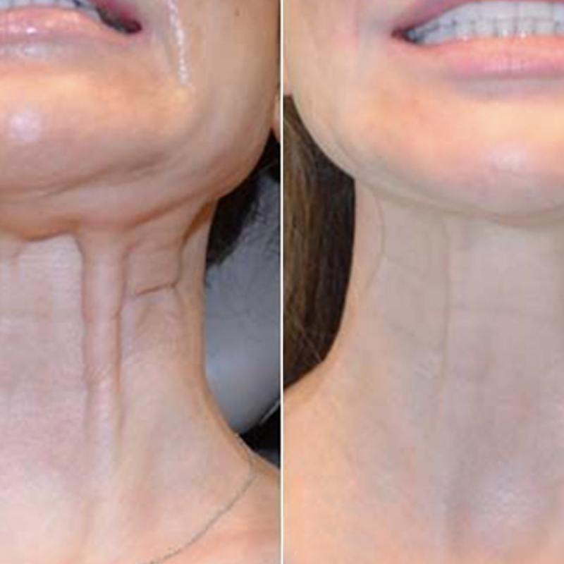 botox en músculo platisma