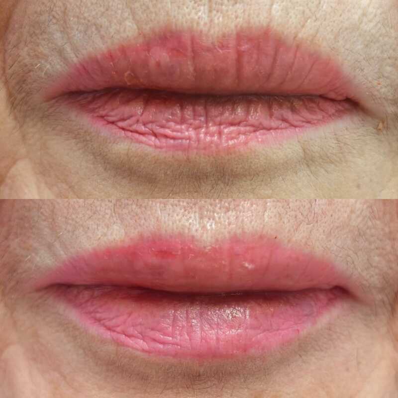 volumen sutil de labios