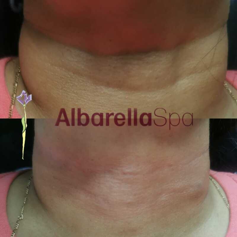 corrección de anillos de venus